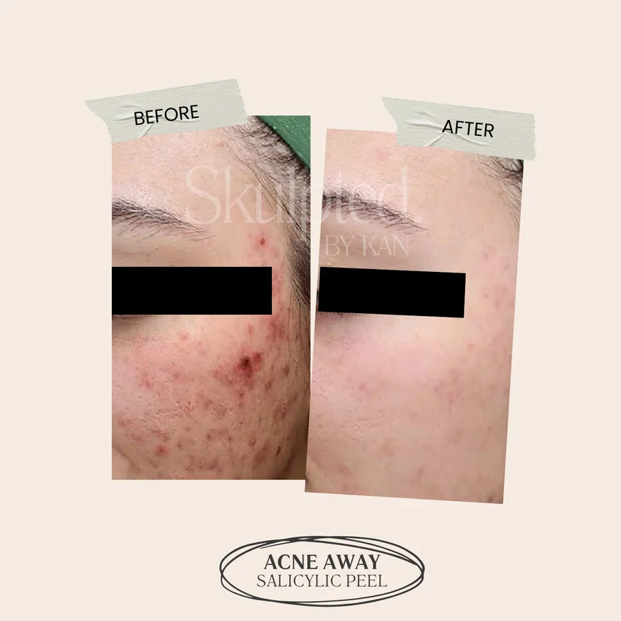 Acne treatment before and after — salicylic peel
