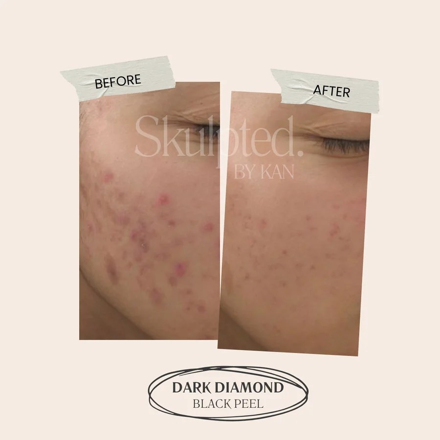 Acne and marks before and after — Dark Diamond black peel