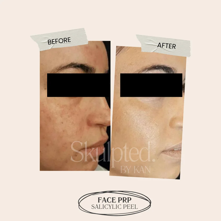 Pigmentation before and after — Face PRP