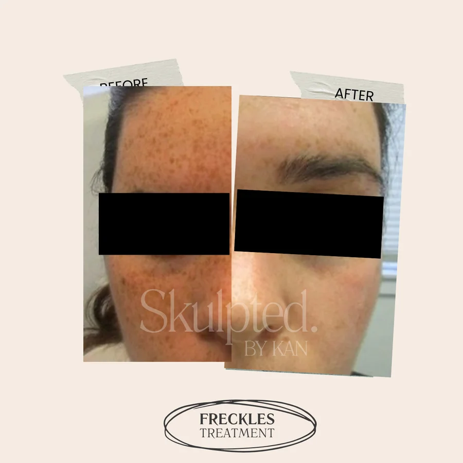 Freckles and pigmentation before and after