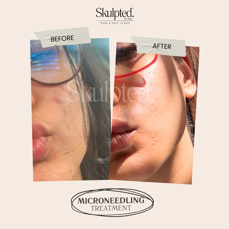 Acne scars before and after — microneedling