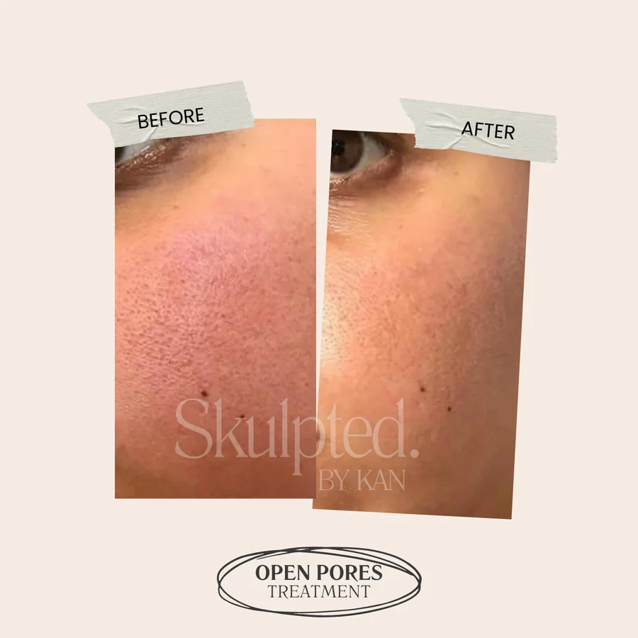 Open pores treatment before and after